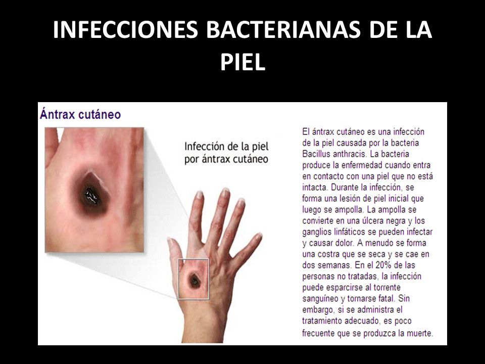 infección bacteriana toque hinchazón de la piel infección bacteriana toque hinchazón de la piel